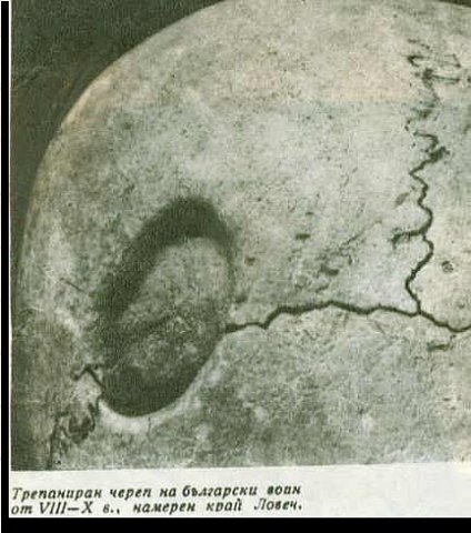 trepanacia
